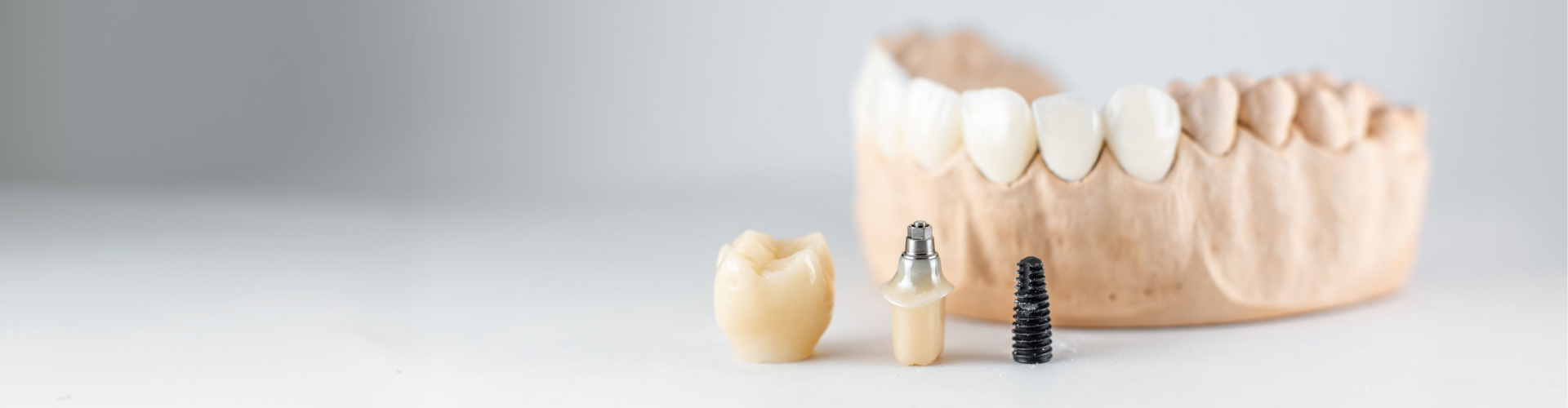 Dental implant components including a crown, abutment, and screw with a dental model.